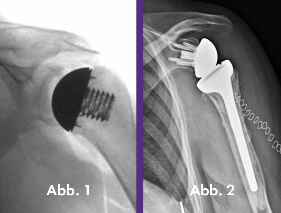 Sportheum_Sportklinik_Fellbach_News_Siegeszug_Inversen_Schulterprothese_Abbild Sportheum Sportklinik Fellbach News Siegeszug Inversen Schulterprothese Abbild